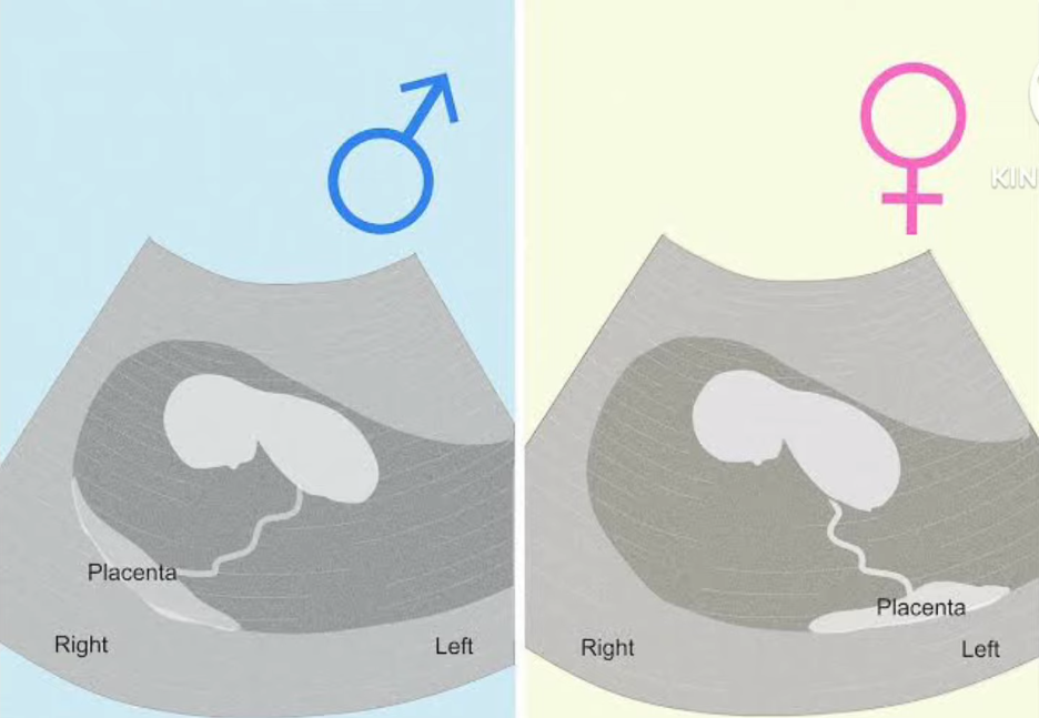 Placenta position telling if its a baby boy or a girl . Ultrasound se kaise pata kare ladka hai ya ladki 