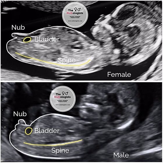 Nub Theory : नब थ्योरी to determine if its a baby boy or a baby girl | Ultrasound se kaise pata kare ladka hai ya ladki 